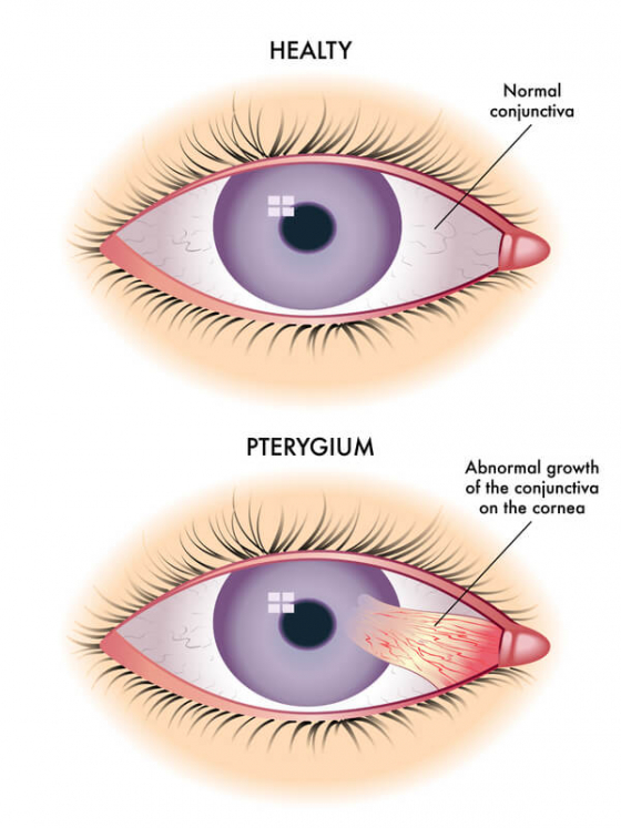 comparision of a normal eye to an eye with Pterygium